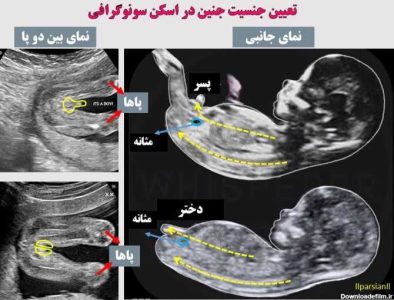 تفاوت جنین دختر و پسر در سونوگرافی