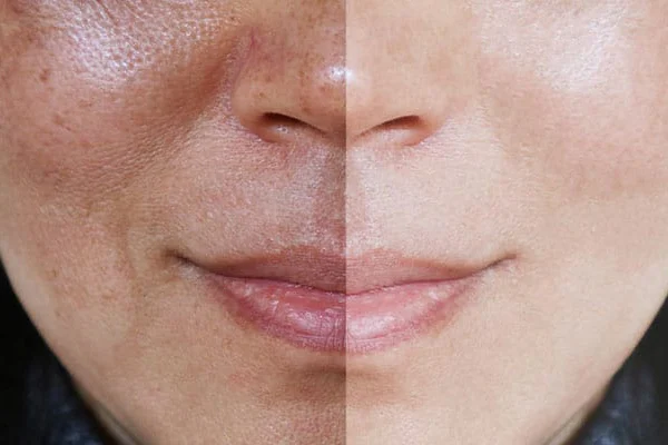  آیا لک های پوستی خطرناک هستند؟